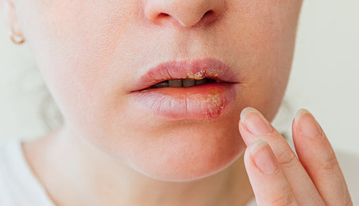 Boutons de fièvre ; le conseil en pharmacie.